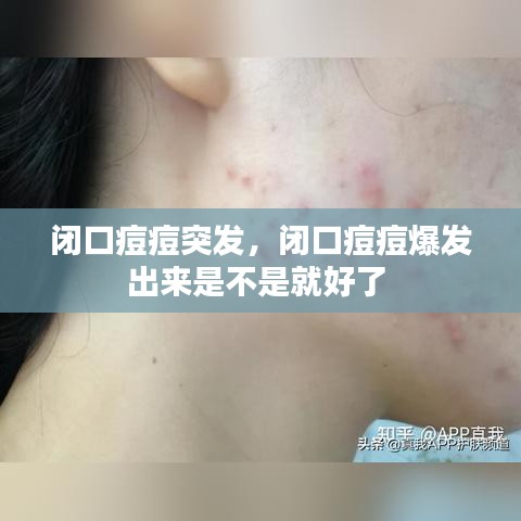 闭口痘痘突发，闭口痘痘爆发出来是不是就好了 
