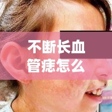 不断长血管痣怎么办？了解、应对与预防全攻略！