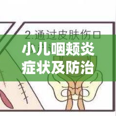 小儿咽颊炎症状及防治，百度权威解答！