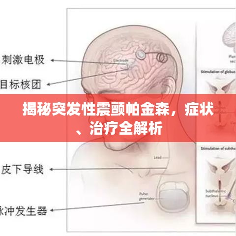揭秘突发性震颤帕金森，症状、治疗全解析