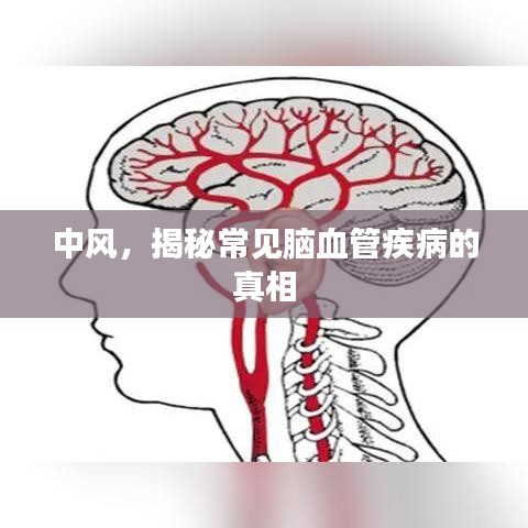 中风，揭秘常见脑血管疾病的真相